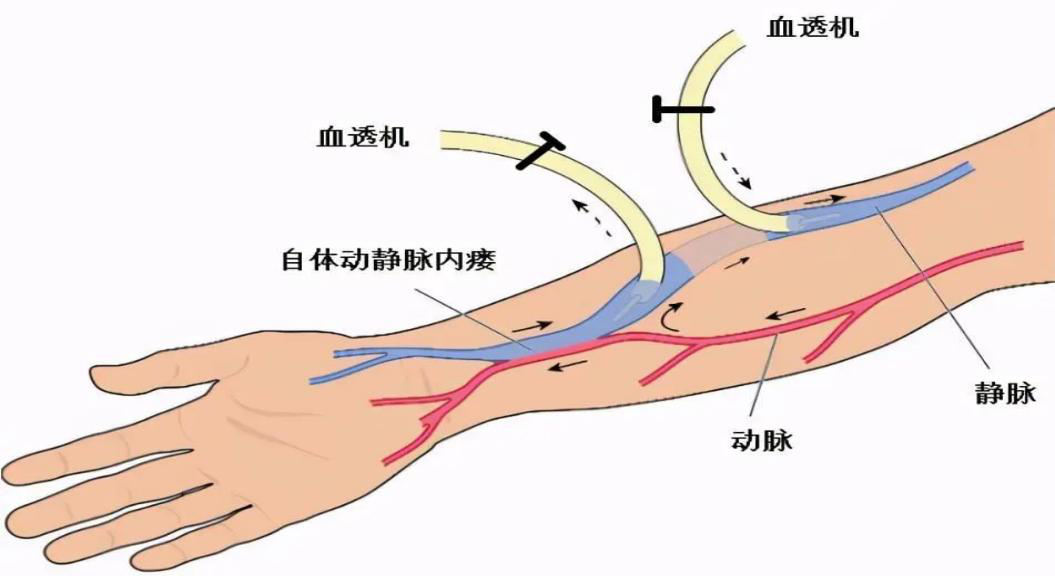 科普|血液透析患者日常內(nèi)瘺的維護妙招